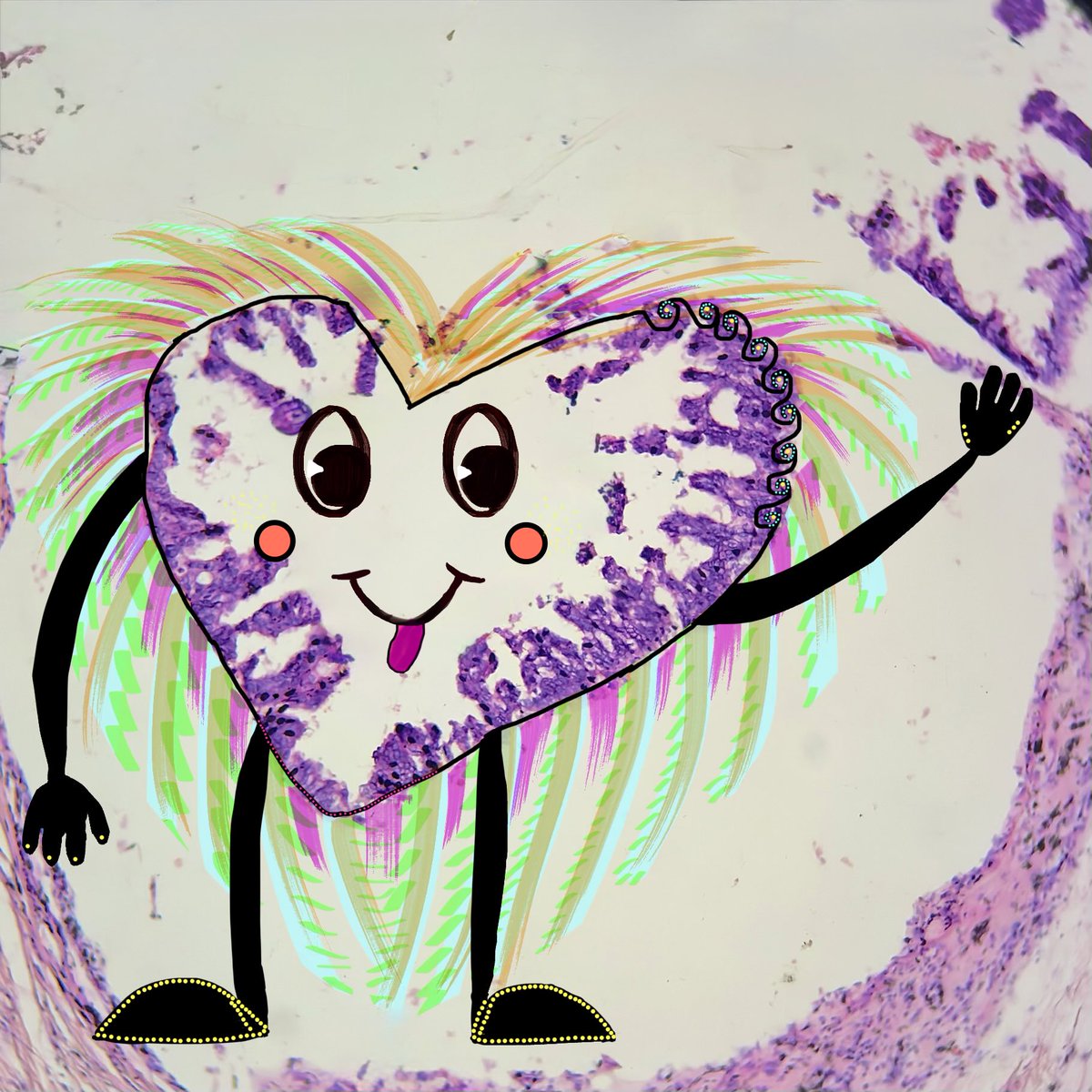 megha_lalcheta's tweet photo. Pathology is boring, they sayπ€¦π»ββοΈBut honestly? Iβm loving every bit of this subject.
I don't mind spending my days looking through my microscope, sipping coffee, with good music in the background.
#Pathart π
#PathX #Pathtwitter #Pathology #Pathresidents #Pathologists #SurgPath https://t.co/wJvSTseROB