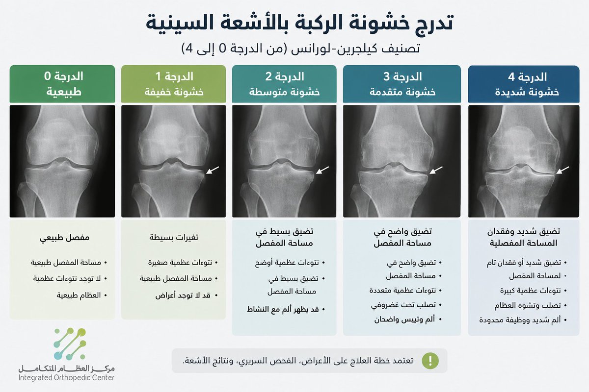 iocenterksa's tweet photo. 4/9 كيف يتم التشخيص؟
يعتمد التشخيص على معرفة طبيعة الألم وفحص حركة الركبة وثباتها وطريقة المشي. وقد تُطلب الأشعة السينية لتقييم المسافة بين العظام، والنتوءات العظمية ودرجة التغيرات بالمفصل، بينما يحتاج الرنين المغناطيسي في حالات محددة فقط. 

#تشخيص_خشونة_الركبة #أشعة_الركبة #مركز_العظام_المتكامل