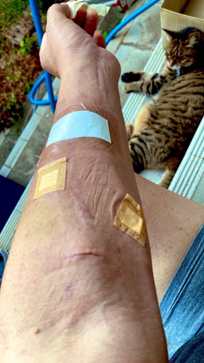 kaz6thlife's tweet photo. ãMy #dialysis #simptom's memoã
ð¥ðð©ââïžð©žðð©»â¿ïžðªð¥Œð¡ïž
#人工è¡ç®¡ ã®è¡çã¯æŠãè¯å¥œã«æšç§»äžãã ããå·ŠæéŠããå
ã¯å³æããå·ãããguitarãäžæ²åŒŸãéã«äœåãäžæããŠãæå
ãæ¯ãè¡æµãä¿ãå¿
èŠãçããããããªãã¢ãŠãã ã https://t.co/TDrrFAoBSC