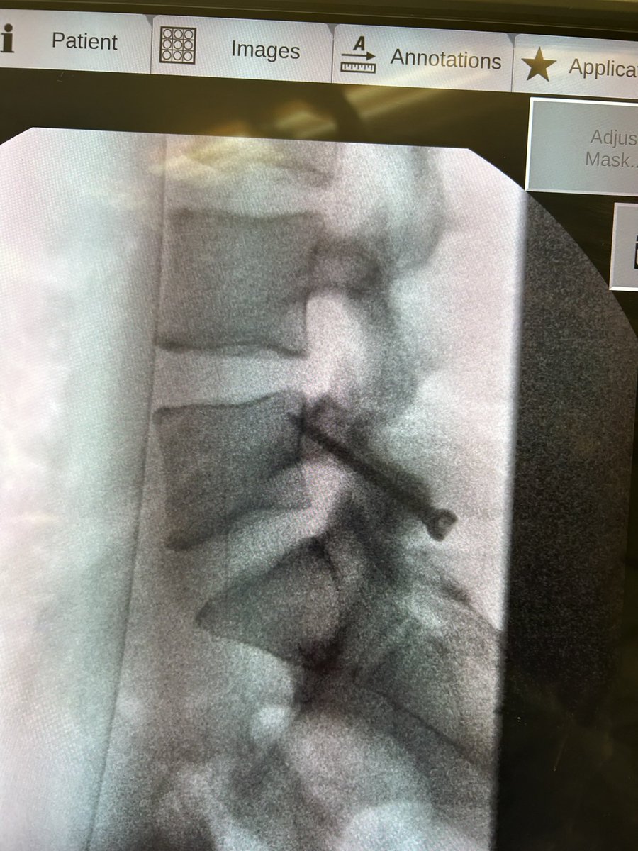 dempseystein's tweet photo. One week post L5 pars repair surgery and I'm feeling great! Exited to get back on the feild soon and grind this offseason! https://t.co/uyFGobhdpI
