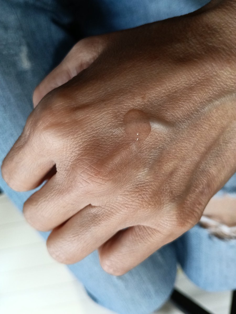 naorevewer's tweet photo. これ使いはじめてから、おばだのキメが細かくなって、毛穴が気にならなくなりました。
しかも肌色もワントーン明るくなってきたの。
#VERAMORE #韓国コスメ #ニードル美容液 #針美容 https://t.co/PRO8NhNQfJ