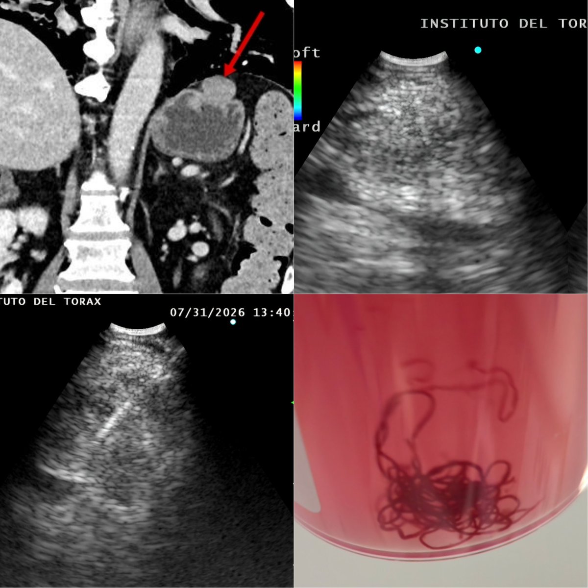 AjalilieE's tweet photo. EUS-B-NA. Beyond interventional pulmonology. Study of possible GIST in a patient undergoing pre-lung transplant evaluation. Respiratory failure supported with HFNC. https://t.co/KXorjm1TgC