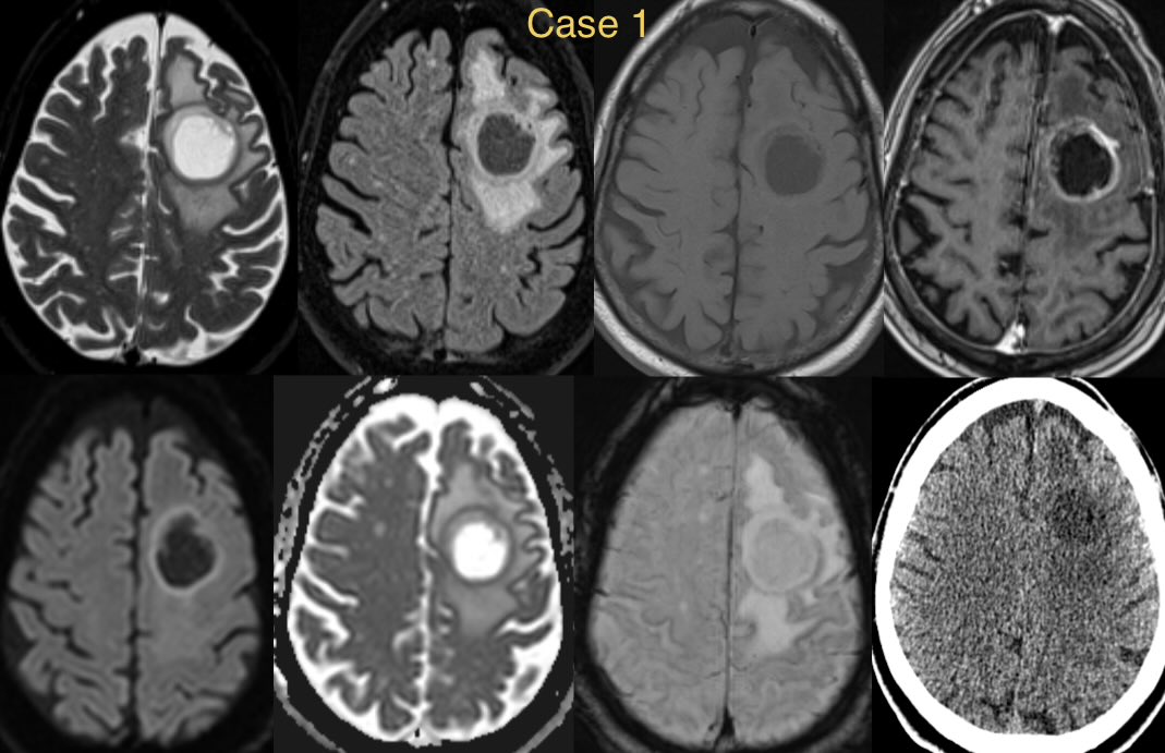 daniel_gewolb's tweet photo. ⭐️ One of these brain lesions is a path proven glioblastoma and the other is an abscess. Can you tell which is which based on the imaging? 

🔷Neither patient is febrile

#medicine #Neurology #neurosurgery #radres #futureradres #ENT #infectiousdisease #MRI #FOAMed @Radiopaedia @TheASNR