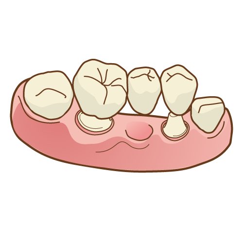 ken9dental's tweet photo. 【新しく保険適用となったCAD/CAMブリッジについて】

2026年の改定で保険診療でCAD/CAMブリッジが新たに保険適用となりました。

CAD/CAMブリッジは、白い材料で作製できるため見た目が自然で、金属を使用しないことが特徴です。
一方で、適応できる症例には条件があり、強度や長期的な耐久性についても考慮が必要な治療法です。

メディアやYouTubeなどではセンセーショナルにメリットばかり強調されがちですが、もちろんデメリットもあります。
耐久度ではジルコニアや金属には到底及びません。

研究学園歯科では、2026年8月現在、CAD/CAMブリッジは導入しておりません。
長期的な予後や耐久性を慎重に判断したうえで、保険診療では生体親和性が高く、軽量で金属アレルギーのリスクが低いチタンブリッジを主に採用しています。

ブリッジにはそれぞれメリット・デメリットがあります。
当院では、お口の状態やご希望に合わせて、保険診療・インプラント・ジルコニアブリッジなども含め、適した治療方法をご提案しております。

詳しくは研究学園歯科の公式ホームページをご覧いただくか、お気軽にご相談ください。