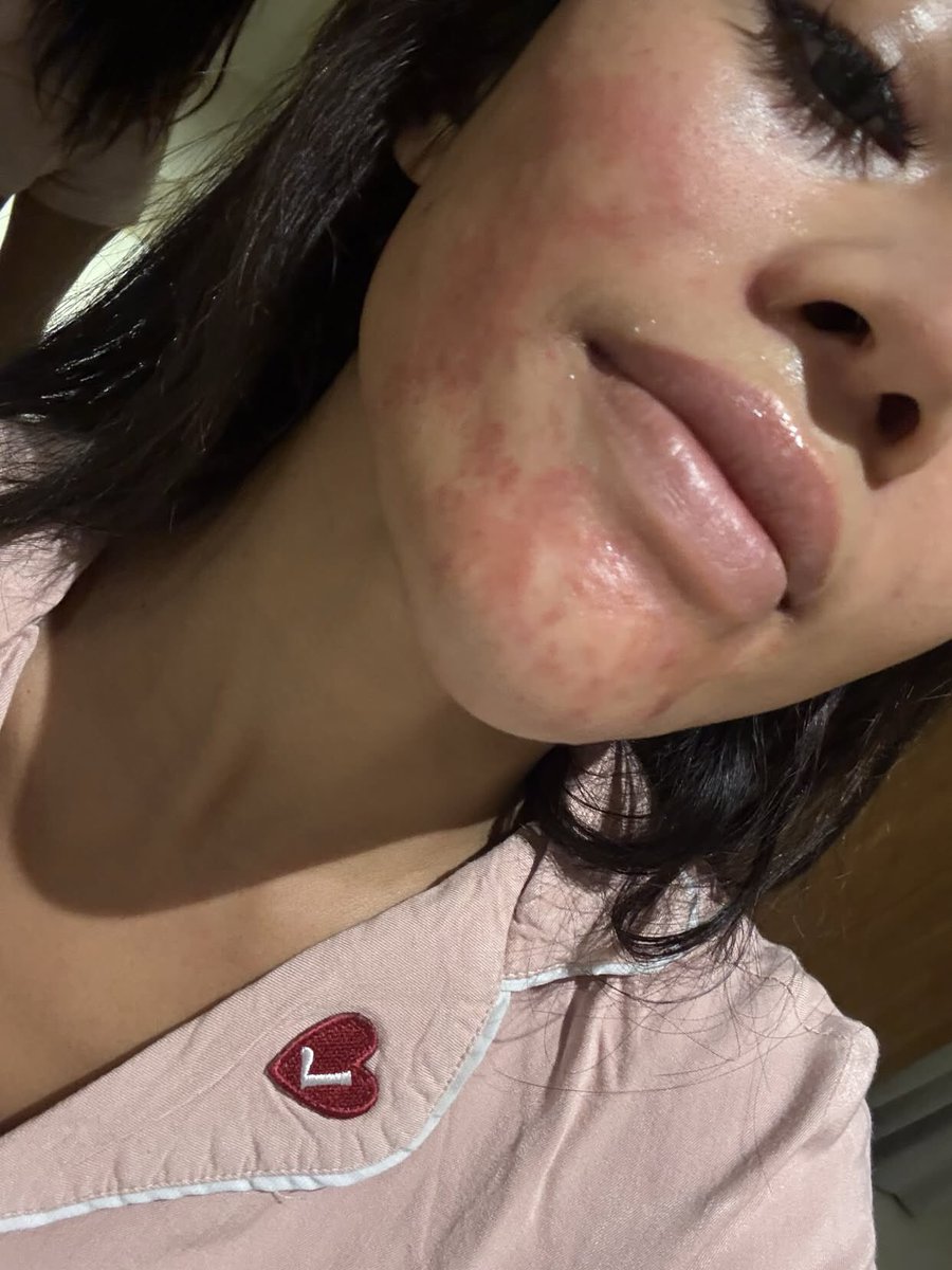 Asunazr's tweet photo. Dear @natashaskincare, mohon tanggung jawab. Hari ini saya treatment di cabang Bali Gatot Subroto, namun numbing cream dibiarkan di wajah saya lebih dari 1 jam. Dokter baru datang setelah saya menghubungi CS karena kulit saya sudah terasa terbakar. Padahal waktu penggunaan anestesi topikal umumnya sekitar 30 menit. Hingga akhirnya wajah saya merah dengan rasa terbakar setelah treatment. 
Saya berharap ada penjelasan dan pertanggungjawaban atas kejadian ini. Treatment: Juvelook￼

@natashaskincare  Dokter beralasan bahwa telatnya tindakan dikarenakan product Juvelook yang belum siap digunakan. Padahal pada saat saya booking di jam 12 siang, CS sudah menginfokan bahwa obat akan disiapkan 3 Jam sebelum saya treatment. 
Saya appointment jam 16.00, keadaan klinik sepi tapi sampai jam 17.50 treatment masih belum dilaksanakan. Padahal saya hanya treatment skinbooster juvelook. Saat ini kondisi kulit saya rasanya sakit dan terbakar

Update: sudah ada pihak Natasha yang menghubungi aku untuk kirim Obat dan Cream 😭🥹 Kemungkinan besok aku akan balik lagi ke natasha, dokternya berjanji akan bantu sembuhin sampai kulit aku normal lagi.￼

cc : elkhaholic