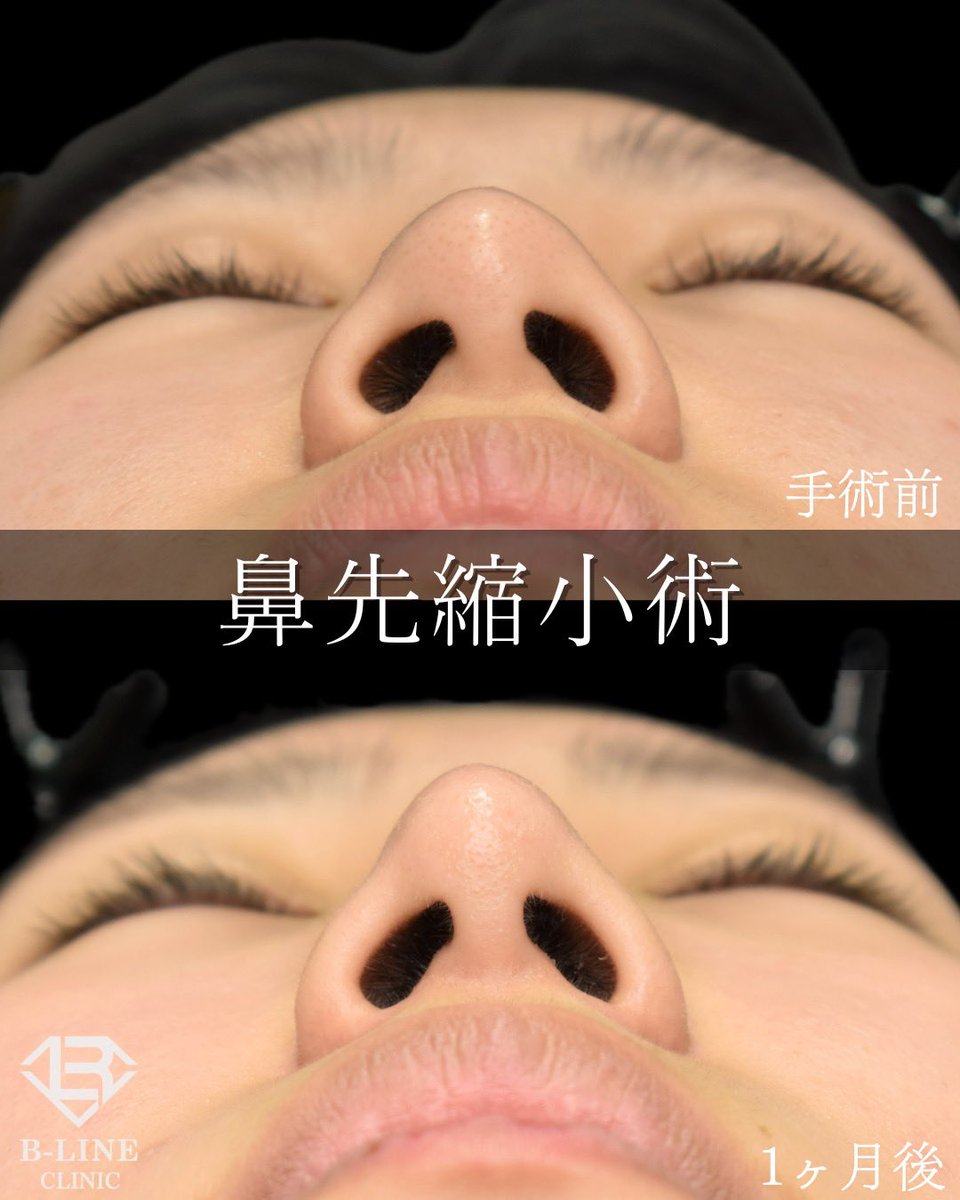 dr_koikeyasu's tweet photo. 【鼻先縮小術】
手術1ヶ月後　⭐️モニター価格15万〜⭐️

鼻腔内からアプローチし、鼻先の脂肪を除去後に軟骨を縫縮することで、シャープな鼻先を形成します！ 傷跡は外に残らないため、休みがあまり取れない方におすすめの手術です。
ミリ単位での調整とデザインのセンスが必須ですので、経験豊富な美容外科専門医にお任せ下さい😌 お鼻はトータルのバランスが大事ですので、診察時に最善の方法をご提案いたします。