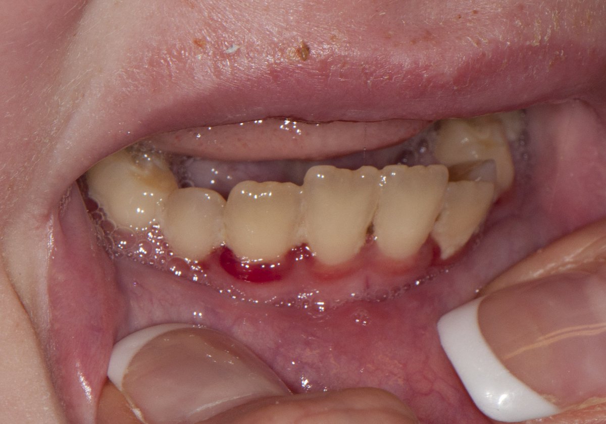 nervemed's tweet photo. Seen in an 8 month old infant only being fed cow milk.

What is the most likely diagnosis❓

A. Rickets
B. Osteomyelitis 
C. Scurvy
D. Hemophilia https://t.co/GlMBt41WwX