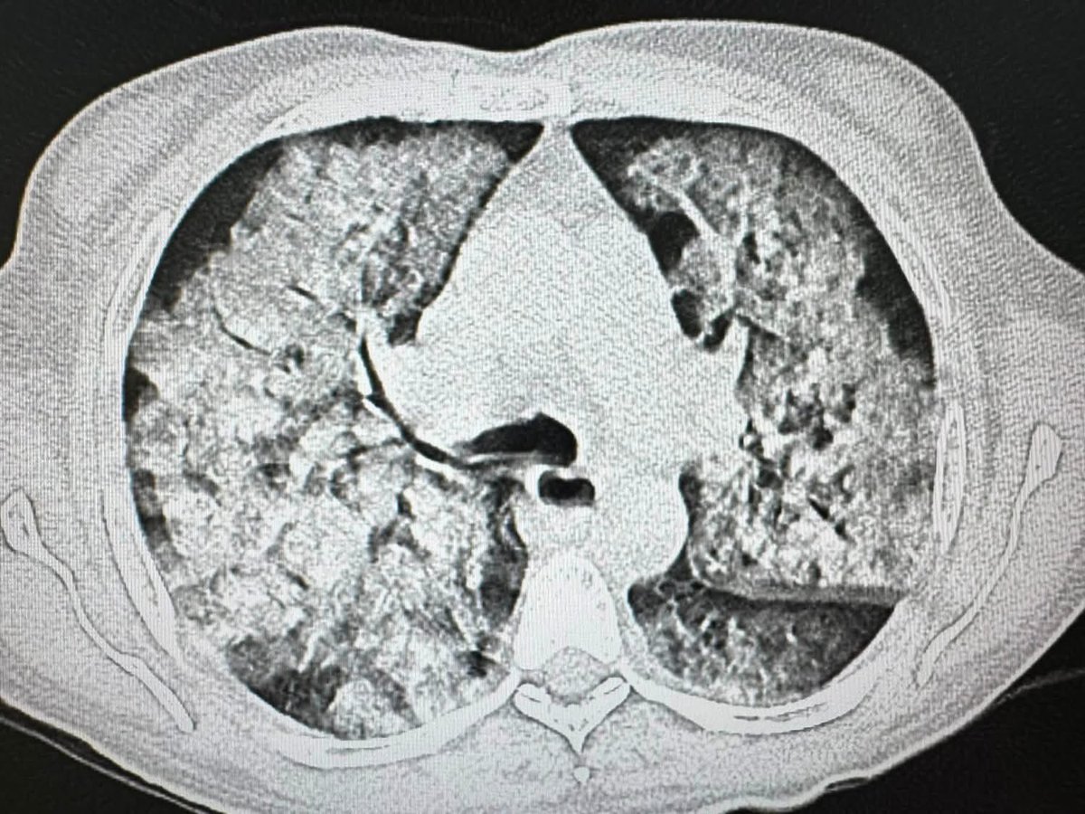 DrAyubaD's tweet photo. Patient on Hemodialysis .

What is the diagnosis ? https://t.co/AUBfD0lQar