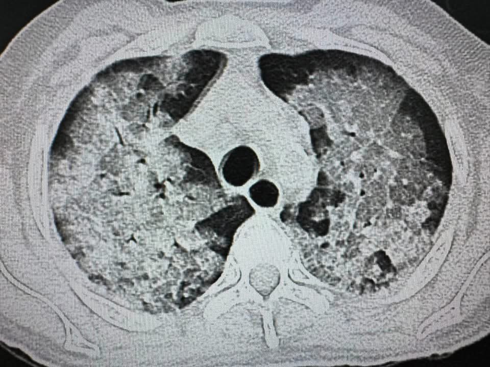 DrAyubaD's tweet photo. Patient on Hemodialysis .

What is the diagnosis ? https://t.co/AUBfD0lQar
