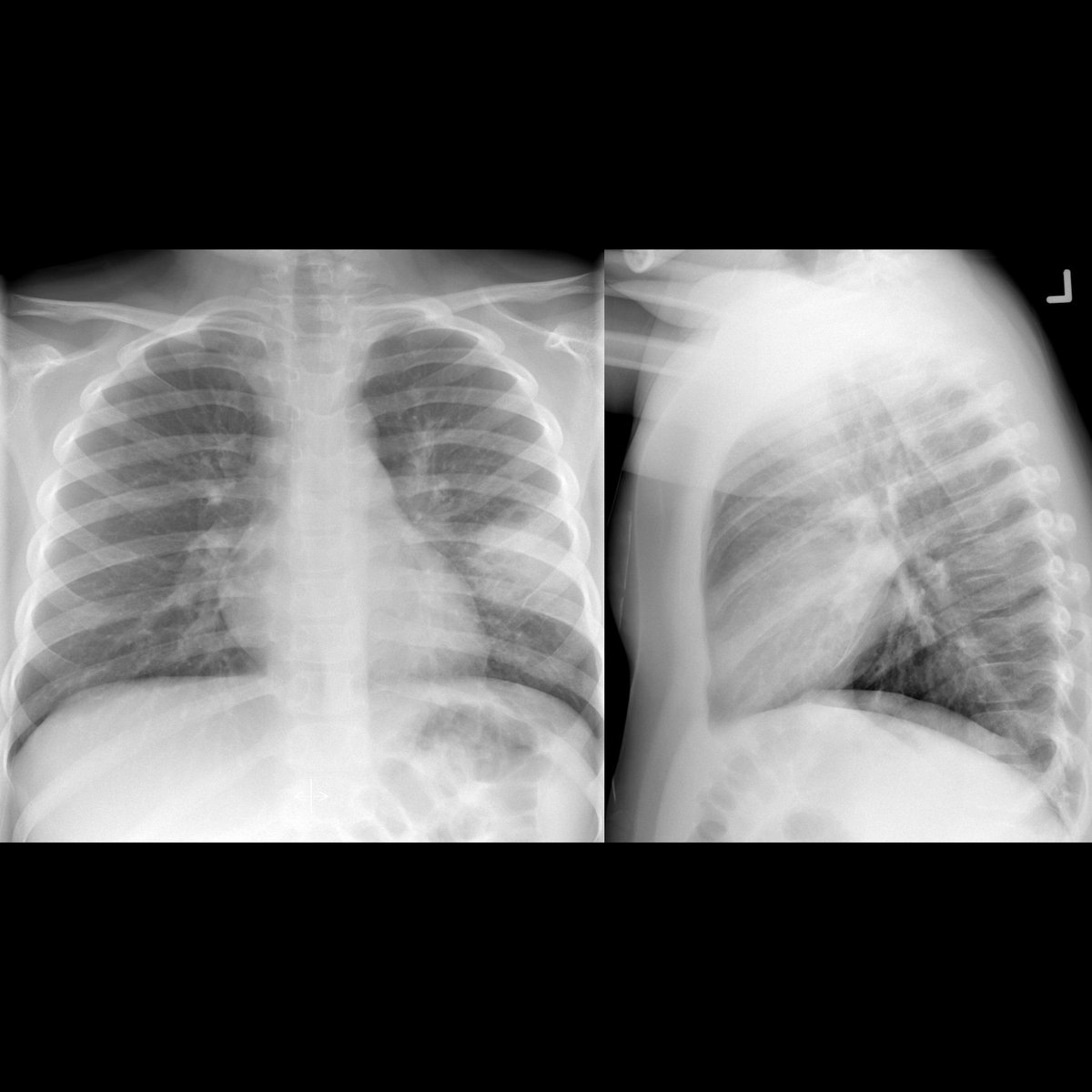 pedsimaging's tweet photo. School ager with cough+fever
CXR PA(left) shows round opacity in lateral aspect of left lung that on lateral(right) projects over heart
#FOAMed #FOAMRad #PedsRad #radiology #pediatrics #radiologia #EmergencyMedicine #medstudent #medicalstudent #paediatrics #pediatria https://t.co/rn2DnQIfJG
