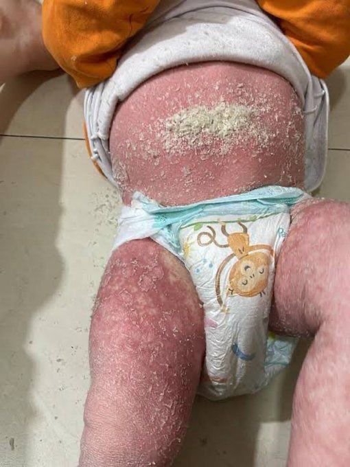 yousefQasem1998's tweet photo. My daughter is crying bitterly from the severe inflammation in her body; her body is burning. 💔😭

https://t.co/45Gj0rpJam https://t.co/TjhAYTqi1c