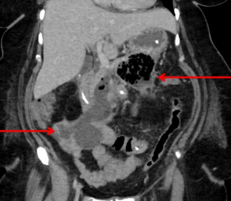 DerbyPBunit's tweet photo. Laparoscopic Infracolic Necrosectomy and Drainage of RIF Abscess
🔴Septic patient but no organ failure 
🔴Narrow window of access for EUS or IR drainage
🔴Single stage clearance of WON and drainage of RIF abscess
➡️Prevents hits of sepsis between multiple procedures
➡️Address both collections at once
➡️Select cases
➡️Benign PB MDT
➡️"One size does not fit all"

Our paper on infracolic approach in @JournalofGISurg:
https://t.co/kcdwWFwSjz

Our collaboration with @BehindTheKnife on MIS for complicated SAP:
https://t.co/Ihu684TBjg

#Surgery #HPB #Pancreatitis