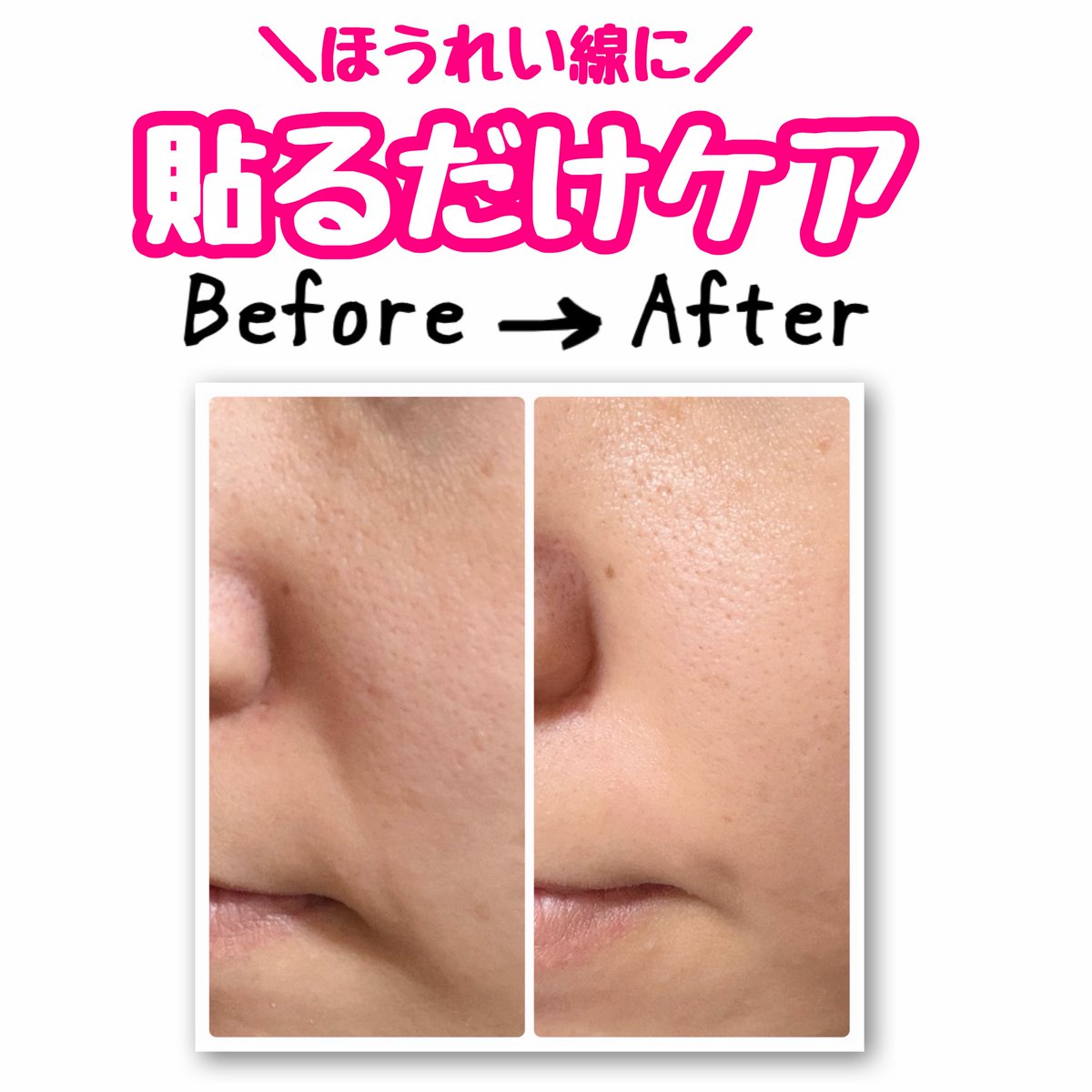 saru6180804's tweet photo. onslo【レチナールほうれい線パッチ(40枚入)】
“寝ながら手軽にケアできる、毎日のほうれい線ケアパッチ🩷”
貼って寝るだけでほうれい線薄くなってて朝からびっくり🤣✨こんなにシワ改善されるなんて..身を持って体験しました！
#onslo #23時のほうれい線ケア #ほうれい線ケア #口元ケア #シワ対策 #PR https://t.co/3eNMZa5IsU