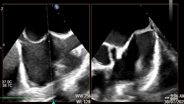 mirvatalasnag's tweet photo. The heart team offers our patients safety..we now have multiple eyes to ensure precise trans-septal puncture & adequate Transcutaneous balloon mitral valvuloplasty 

MG 2 & trace MR post-procedure

#ThreeMusketeers @drptca @MogneeA @mirvatalasnag 😇

Reference @SCAI 
https://t.co/JLiXuw1xJu