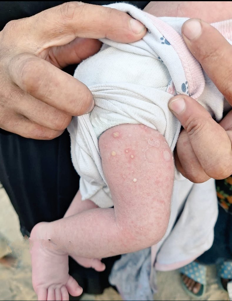 yousefQasem1998's tweet photo. My little girl cries endlessly... from morning until night, as if the pain never gives her a single moment of peace. No one truly sees what she is enduring, or how scabies slowly steals her comfort and consumes her tiny body. 😭
https://t.co/45Gj0rpJam https://t.co/yta4TXvcsS