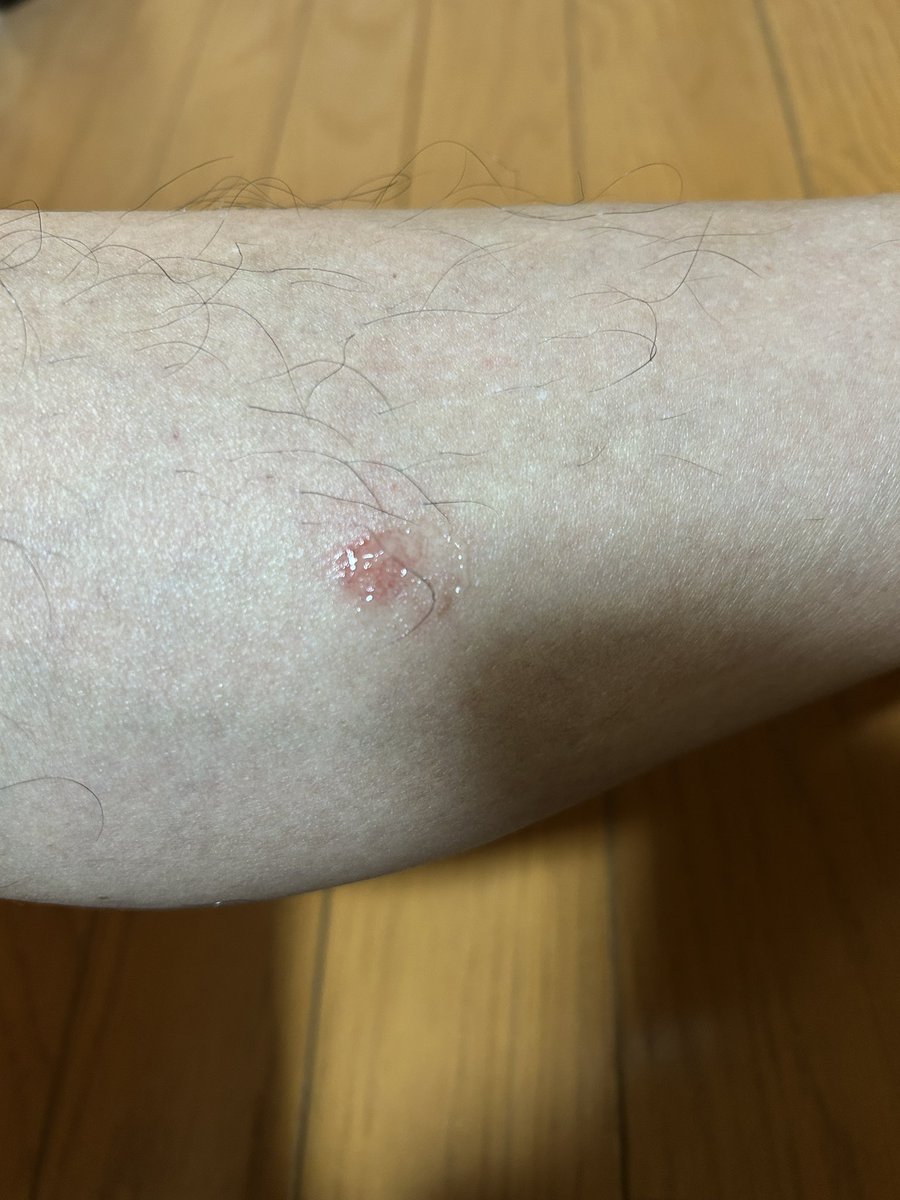 RhHmoA6doS59526's tweet photo. ダニ！ご注意下さい！
掃除では間に合いません！
去年×2
今年×12
異常発生かも？
特に赤ちゃん！ご注意を⚠️

お見苦しい脚で🙇‍♂️ https://t.co/4vjg6wn3Tz