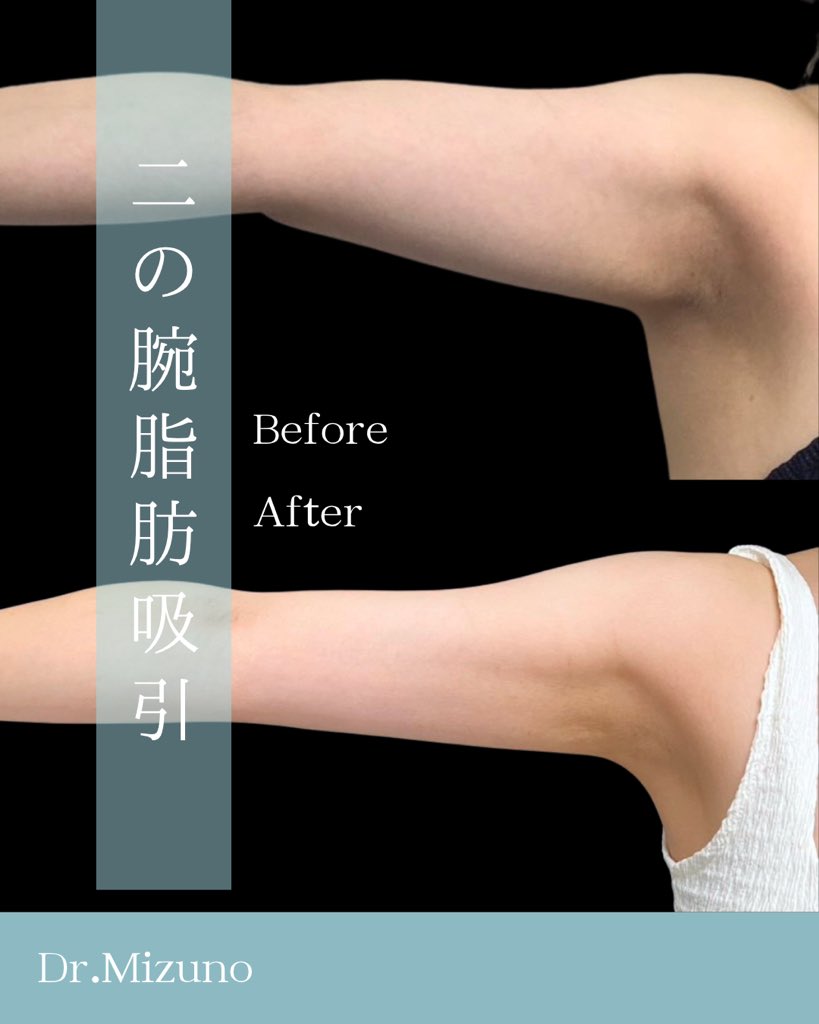 _dr_pon_'s tweet photo. ダイエットで一番最後まで残るのが二の腕。

「体重は落ちたのに二の腕だけ変わらない」

このご相談、本当に多いです。

二の腕脂肪吸引では、脂肪細胞そのものを減らすことで、すっきりとしたラインを目指せます。

※症例写真は加工なし。
腕の太さ・輪郭は編集していません。

👨‍⚕️執刀医：水野Dr.
📍名古屋駅前ゆう美容クリニック

#二の腕脂肪吸引 #脂肪吸引 #美容医療