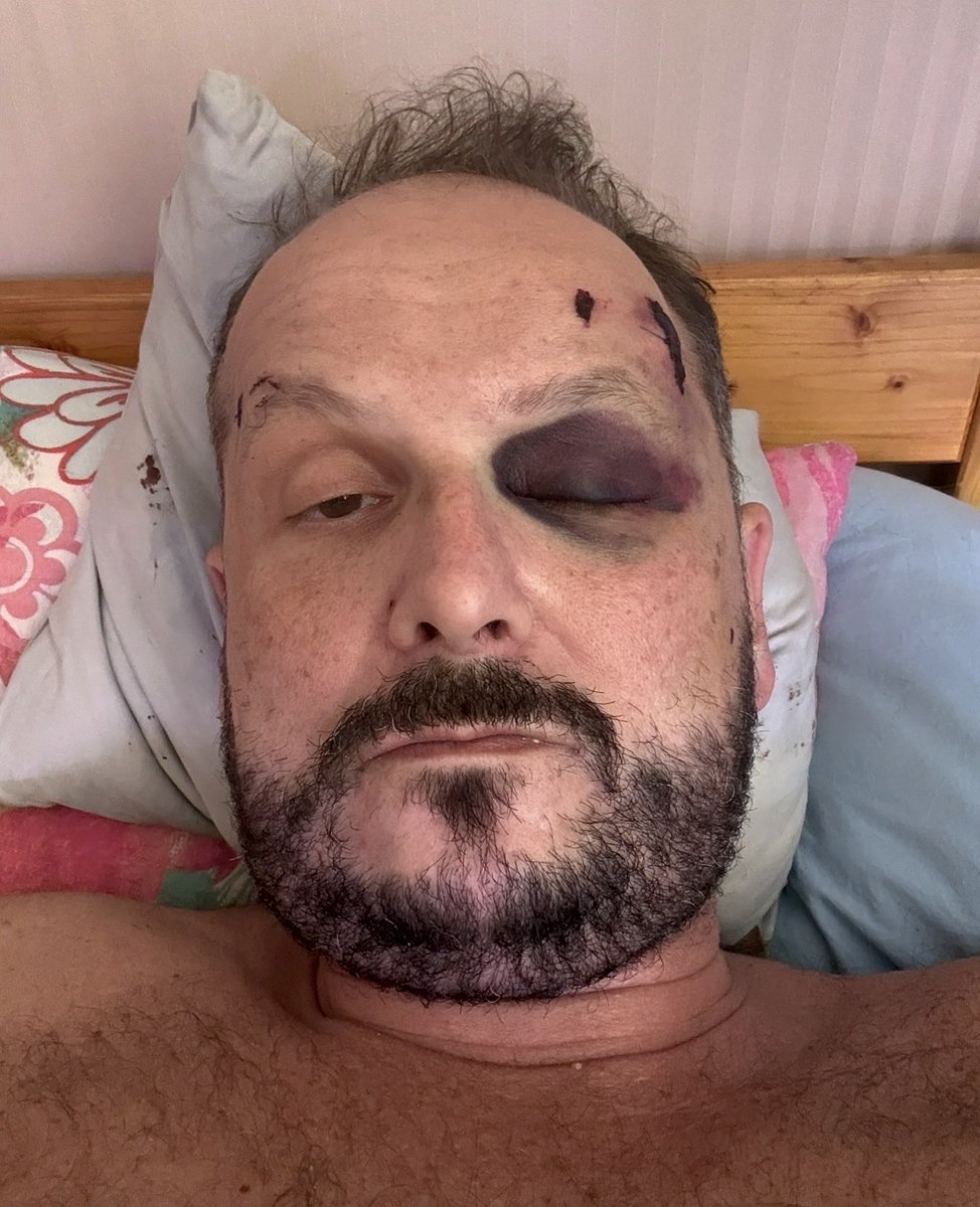 MKierkus's tweet photo. Nikt lekarzowi nie chciał pomóc . 
Zostałem brutalnie pobity przez tych samych ludzi którzy są w układzie Szprotawskim . Pobił mnie Pacjent i Policjant 
Zbigniew Stonoga 6 h po pobiciu był już u mnie 
Nie wszyscy lekarze to oszusci
Jestem lekarzem poz który pracuje w 1 miejscu
@zstonoga2025 @zurnalistapl @portalzeropl