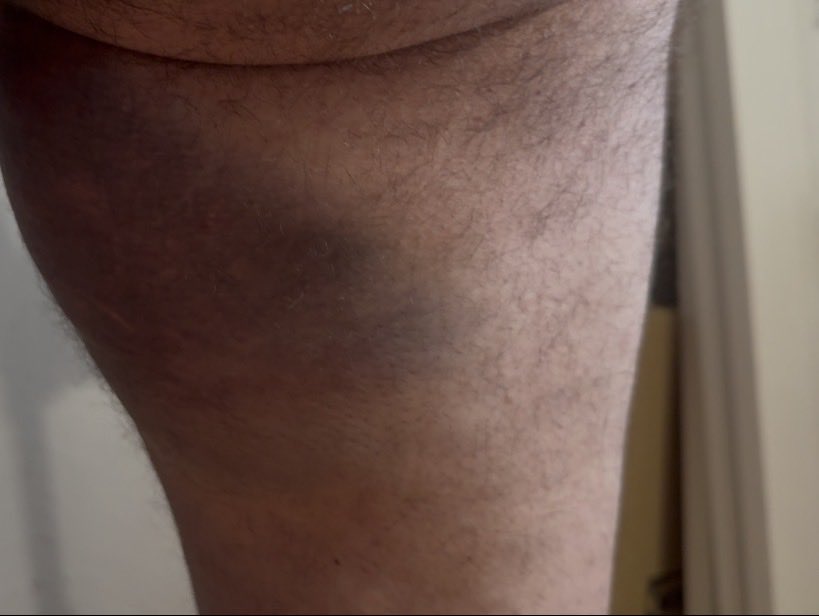 MKierkus's tweet photo. Nikt lekarzowi nie chciał pomóc . 
Zostałem brutalnie pobity przez tych samych ludzi którzy są w układzie Szprotawskim . Pobił mnie Pacjent i Policjant 
Zbigniew Stonoga 6 h po pobiciu był już u mnie 
Nie wszyscy lekarze to oszusci
Jestem lekarzem poz który pracuje w 1 miejscu
@zstonoga2025 @zurnalistapl @portalzeropl