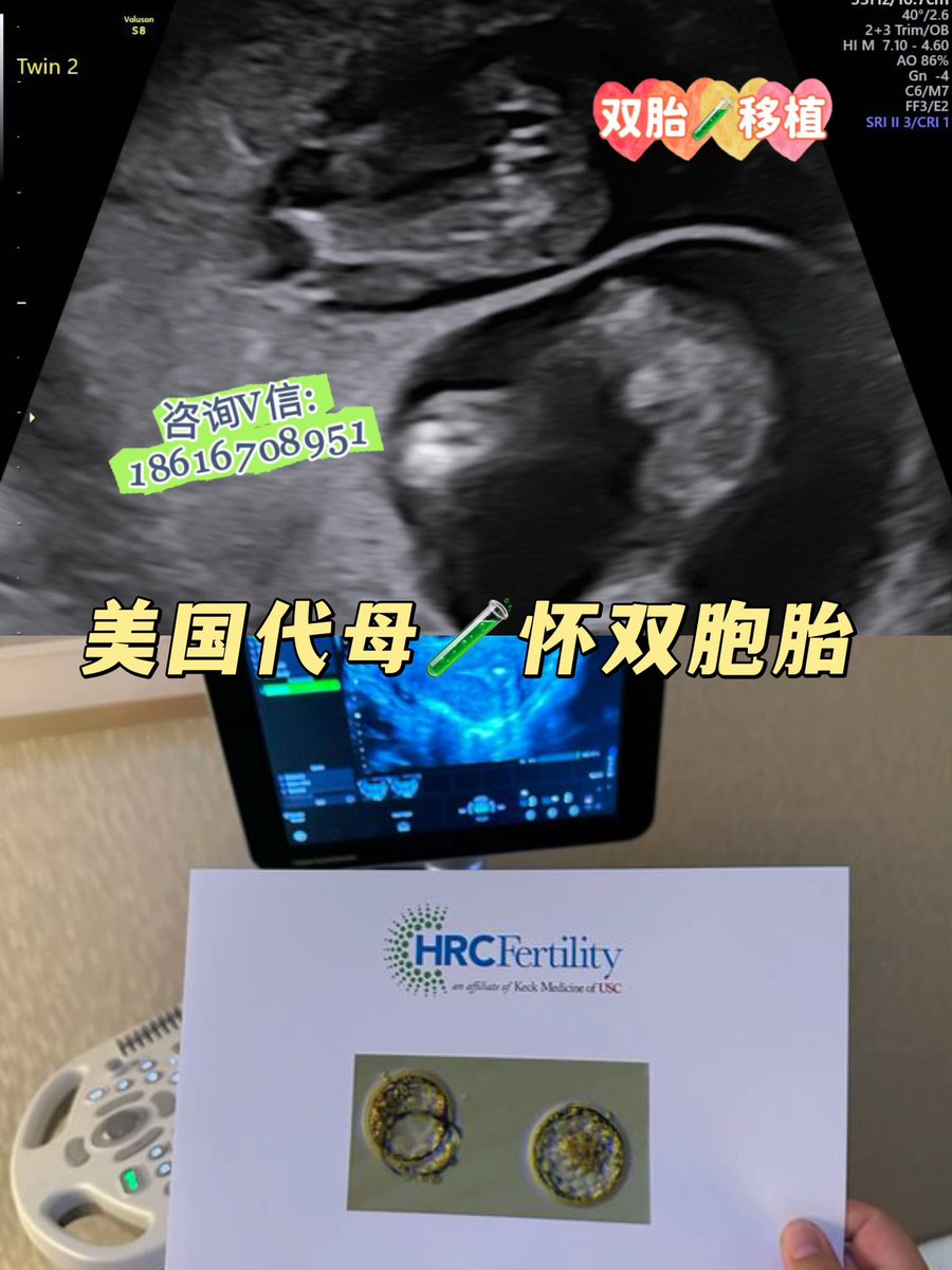 kendria_rod's tweet photo. 中国90后客人的美国代母已出双胎心☺️怀的是一对龙凤胎，在代孕妈妈试管婴儿移植胚胎的时候，直接放入1颗男孩胚➕1颗女孩胚，两宝宝全部成功上岸！恭喜准父母一次儿女双全，升级四口之家！

高龄夫妻代孕 不孕不育 供卵供精基因定制 性别指定🈯️包出生 卵子库精子库 单身合法代孕 塞班/格鲁吉亚代孕 https://t.co/bTrmC3SY7Z