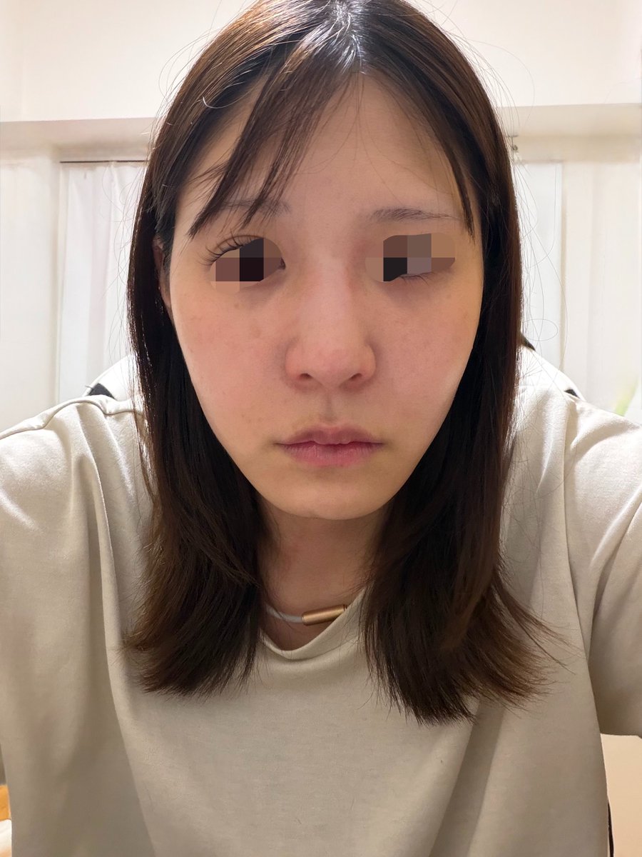 JYe1g's tweet photo. 唇ヒアル全部溶かして、入れ直してきた
初人中ボト打った🌟 https://t.co/N2cj8zBsWf