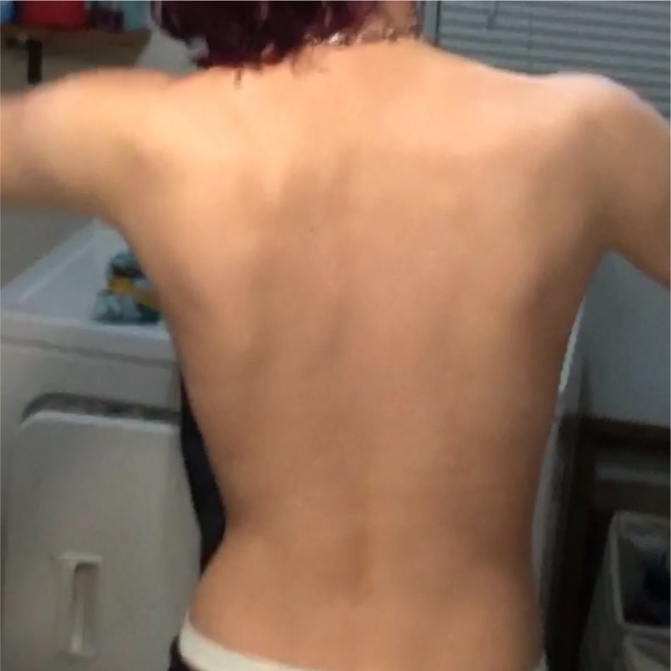 taboofish's tweet photo. 2020-2026. crazy how i look the exact same but so different just bc im older and 10lbs lighter. #edrtwt #bodycheck #shedtwt https://t.co/898aQAZlbC