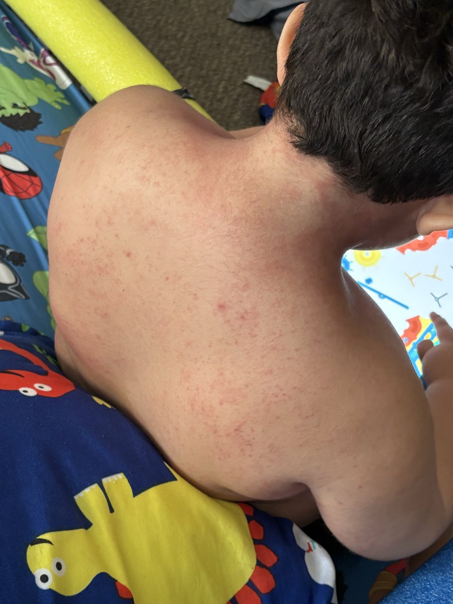 mirandais2's tweet photo. @grok is his eczema drying out like getting better? https://t.co/bSsxDliBZC