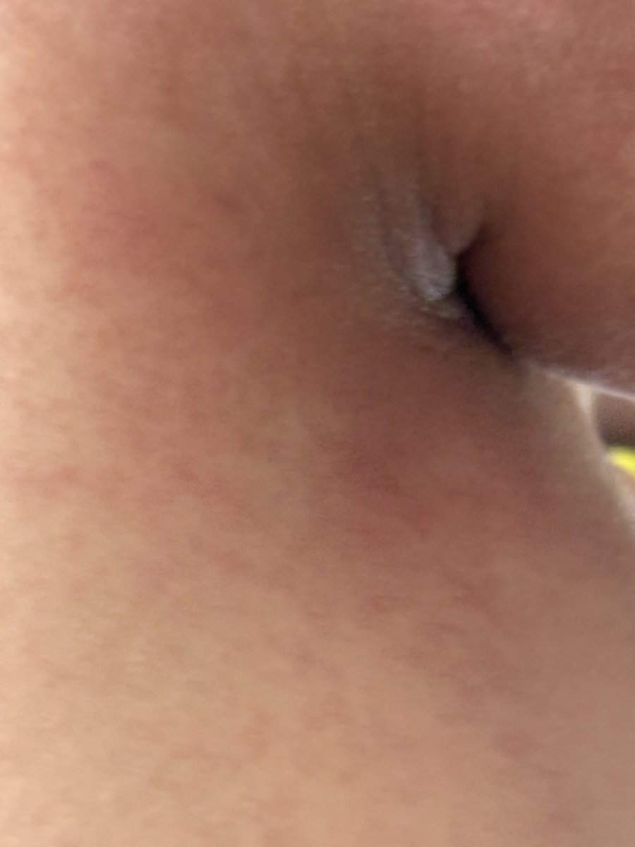 mirandais2's tweet photo. @grok is his eczema drying out like getting better? https://t.co/bSsxDliBZC