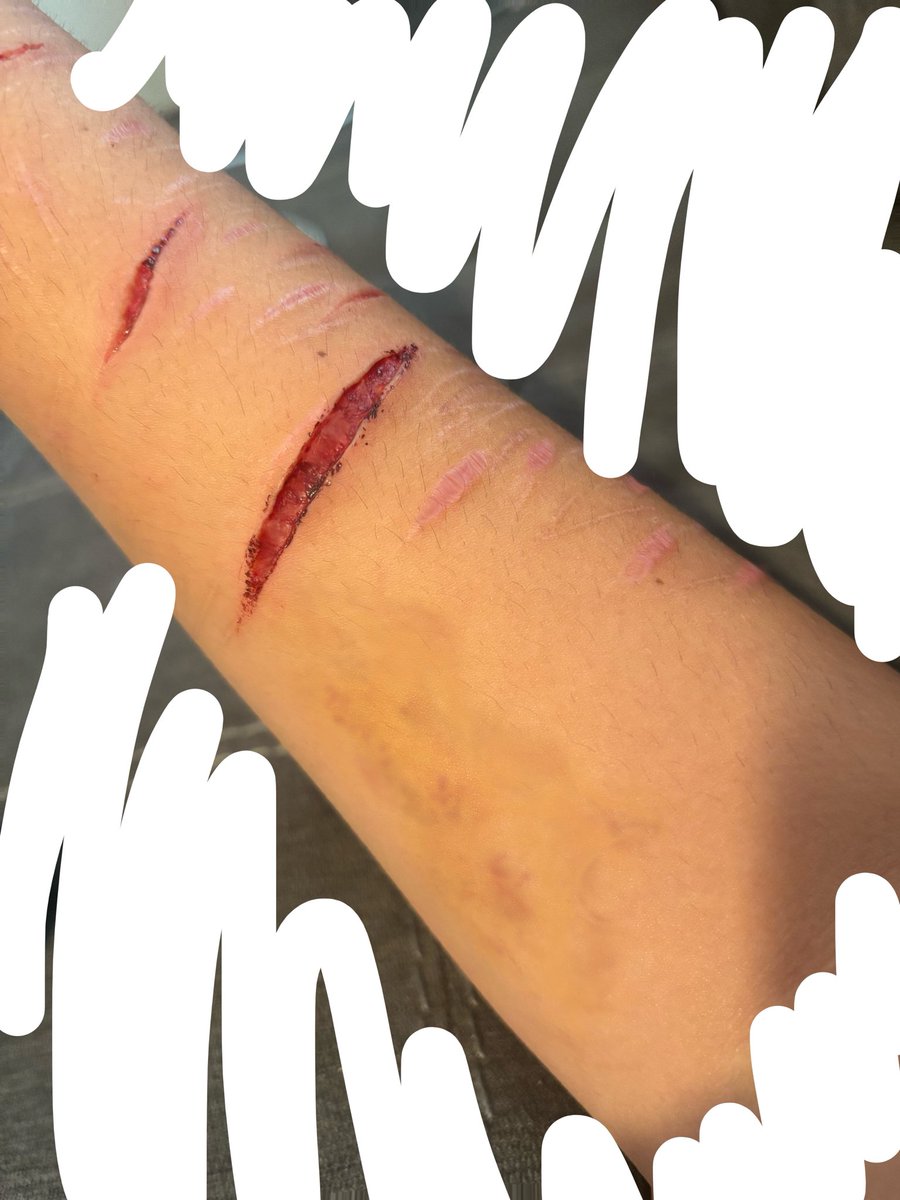 heidiimesser's tweet photo. Gosh I love that bruise 
( All fake SFX makeup!! )
Old picture from yesterday, I ended up snipping off the edges of the cut, cause it was being a bum and closing 🙄

I might reswipe it a few times, as it’s more shallow than I thought it was 😣
#shtwt 
SFX MAKEUP https://t.co/i6DkA5eszY