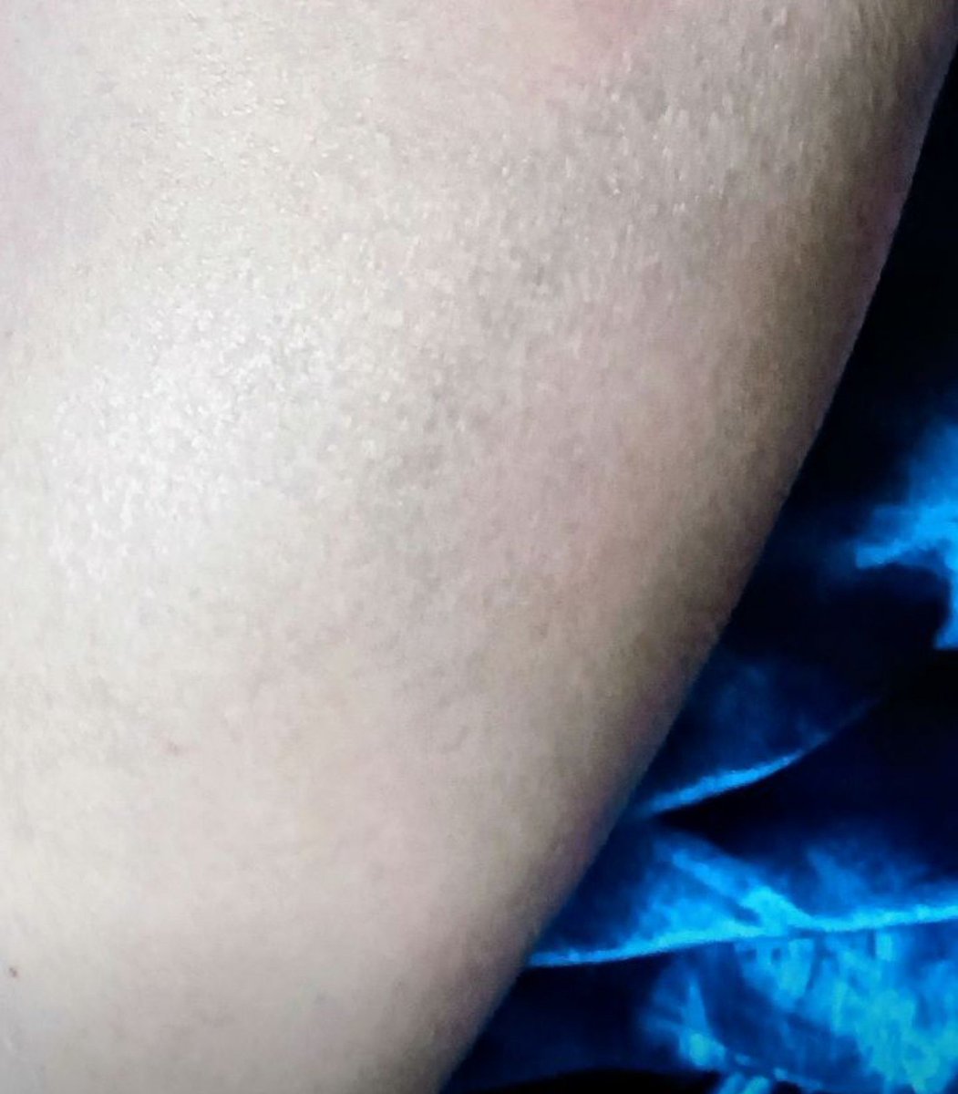 TespenMartin's tweet photo. "JAMBON DE VERSAILLES"
me disait mon frère quand j'étais petite.
Ma jambe droite présente une morsure de dents métalliques d'un BOURBON
(espagnol, mon voisin) nommé "JAIME" pendant que j'étais en exil à Thaïlande. https://t.co/L3y9s8BXgD
