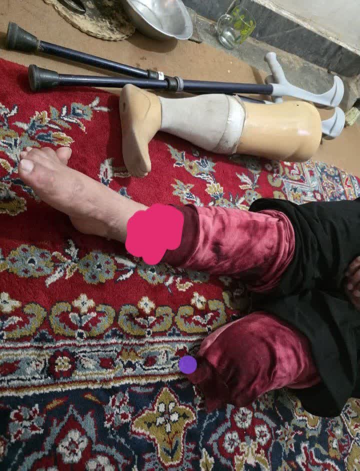 laleh_13245's tweet photo. بر اثر بیماری نا علاج مجبور شد یک پایش رو قطع کنن، الان پای دیگرش هم عفونت کرده و نیاز به عمل جراحی داره، ۳۵ میلیون هزینه عملش هست، هر کسی با هر نیتی میتونه کمک کنه تا این خانم بیشتر از این آسیب نبینه
5892101590979155 
خانم توانا پور بانی جمع آوری کمک ها هستن 

#ریتوییت https://t.co/7XCHDaMdsZ