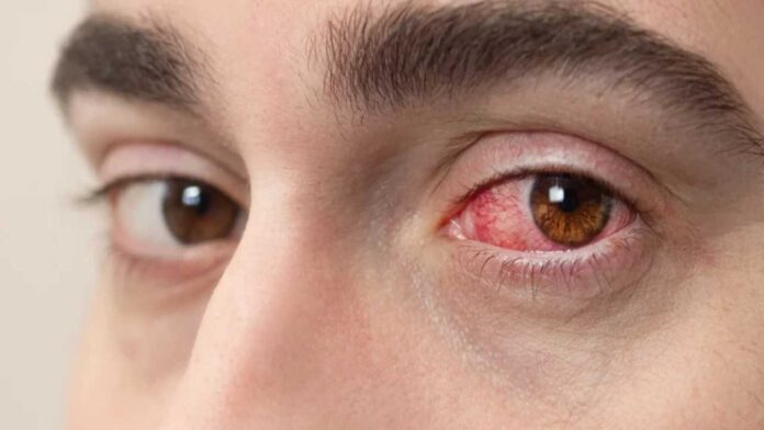 Elperiodiquito's tweet photo. Especialistas en salud en el estado Aragua advierten de un notable incremento en los casos de alergias oculares y afecciones respiratorias en la entidad. Este repunte está directamente asociado al inicio de la temporada de lluvias https://t.co/NIMA93pgVm https://t.co/8H37j1yHre