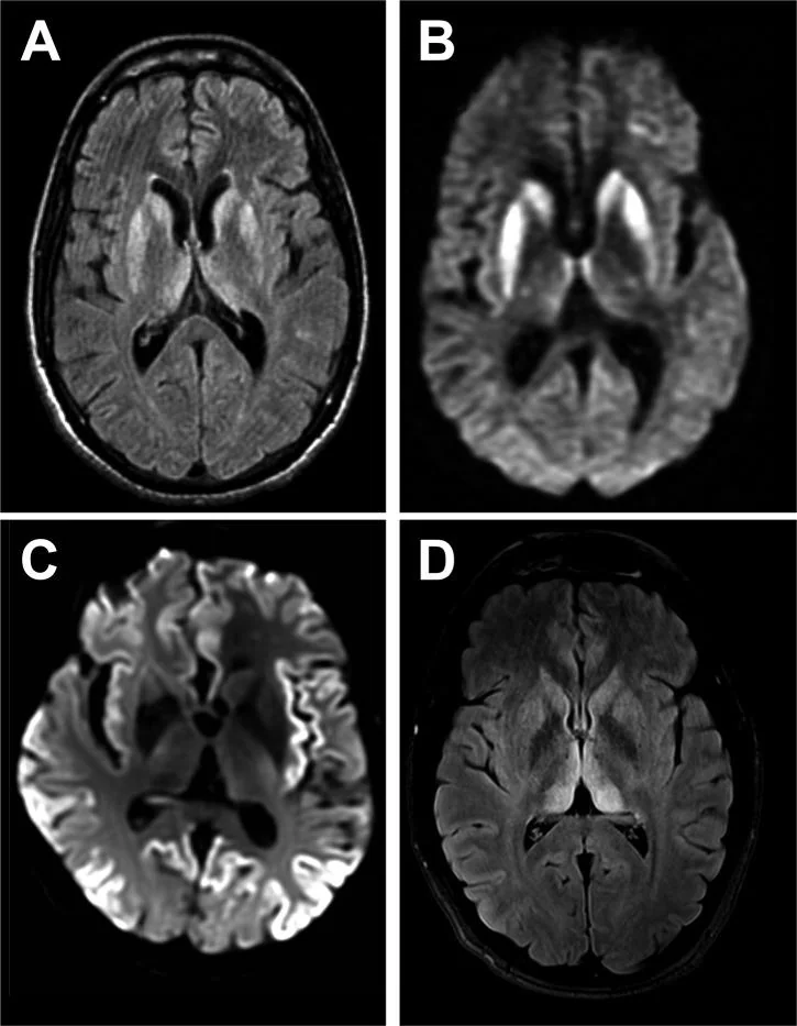 ImtiazMadmood's tweet photo. A single misfolded prion protein in the brain can cause a rapid neurodegenerative disease known as sporadic Creutzfeldt–Jakob disease (CJD). There is no known and cure and is 100% fatal.

A prion isn’t a living thing like say bacteria or germs. Because a protein is not alive. 

There's been some really interesting research into a vaccine antibody treatment but unfortunately they need more funding to reach phase II clinical