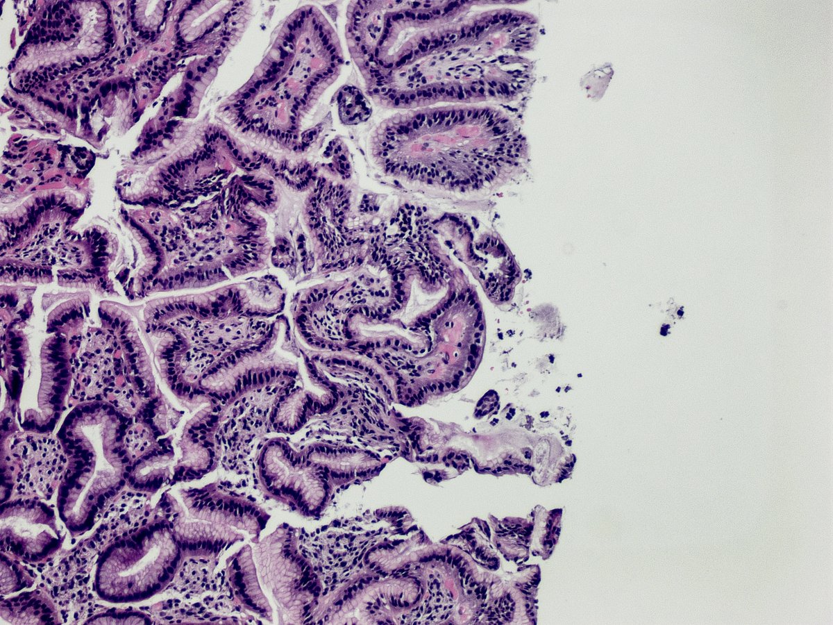 sayedalmahari's tweet photo. Sarcina is one of the most distinctive organisms encountered in gastrointestinal pathology. Its characteristic packet-like tetrads are usually a clue to delayed gastric emptying or gastric outlet obstruction rather than primary infection. #Pathology #Histopathology #GIPath https://t.co/mp0F9GGNbS