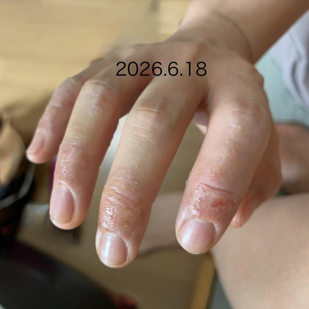 C6cCj's tweet photo. 炎症期から乾燥期に入るまでが長かった
ステロイドはわたしにとって一旦良くなってもじゅくじゅくを助長するだけ😭
絶対に使わない。

デトックスティーと乳酸菌
保湿
暇な時は温泉行くことにして
随分と変わった
じゅくじゅく期はしんどい😢 https://t.co/mqR1WGKUyr