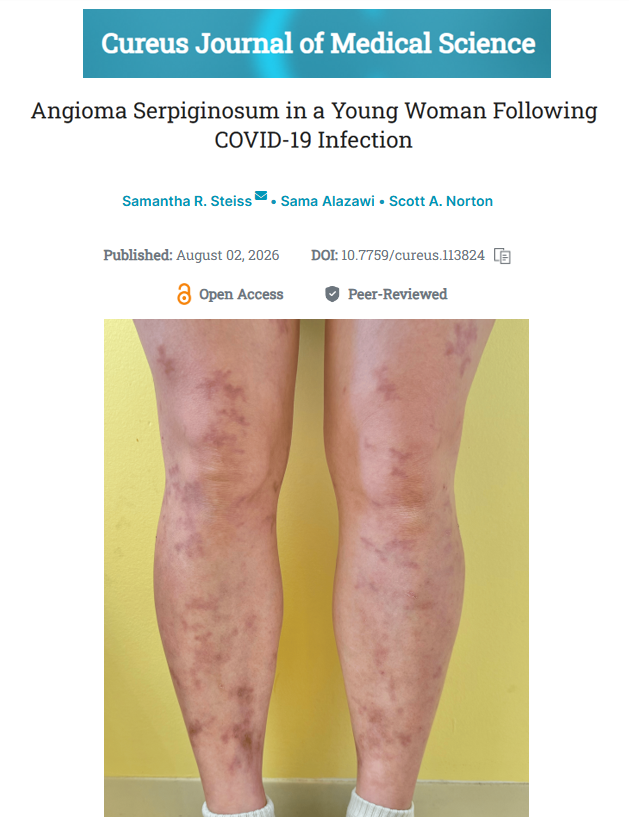 BigBadDenis's tweet photo. A case study found a 25-year-old woman developed a rare blood vessel skin condition one month after COVID-19 infection. Researchers say it adds to growing evidence that COVID-19 can damage blood vessels and may trigger unusual vascular conditions after infection. https://t.co/Y1O2EbjgYP