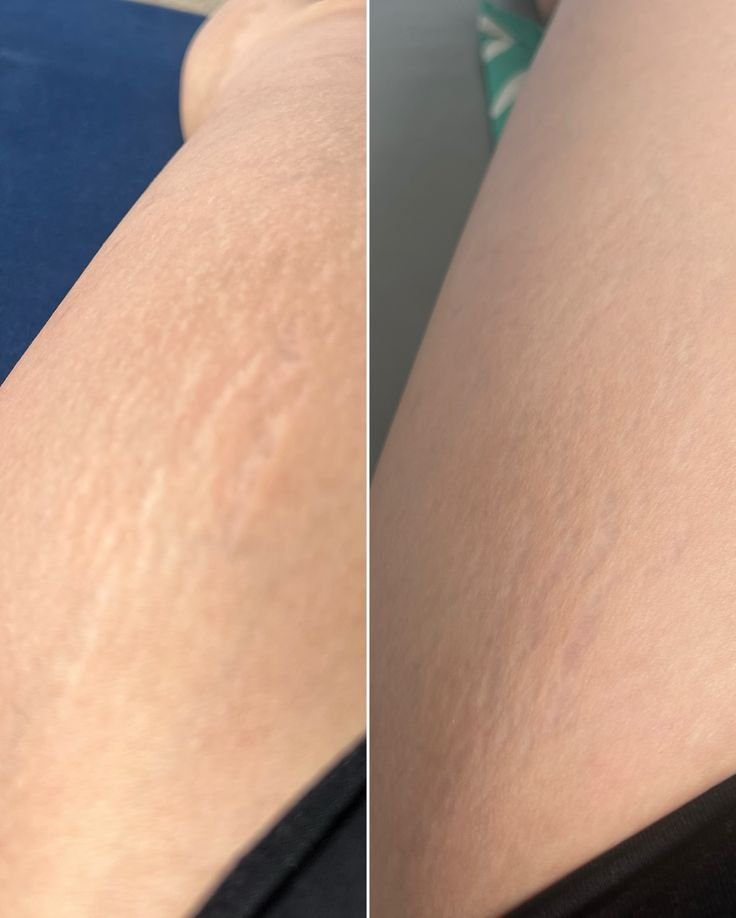 Zevoralhr7's tweet photo. AKU BARU TAU 😭 Ternyata stretch mark itu nggak bisa hilang sepenuhnya,tapi masih bisa dipudarkan sampai tampilannya lebih samar.Aku lagi coba pake produk buat bantu nyamarin stretch mark,lumayan banget buat yang lagi cari perawatan 🫶

Before                                After https://t.co/tyhdG7gREk