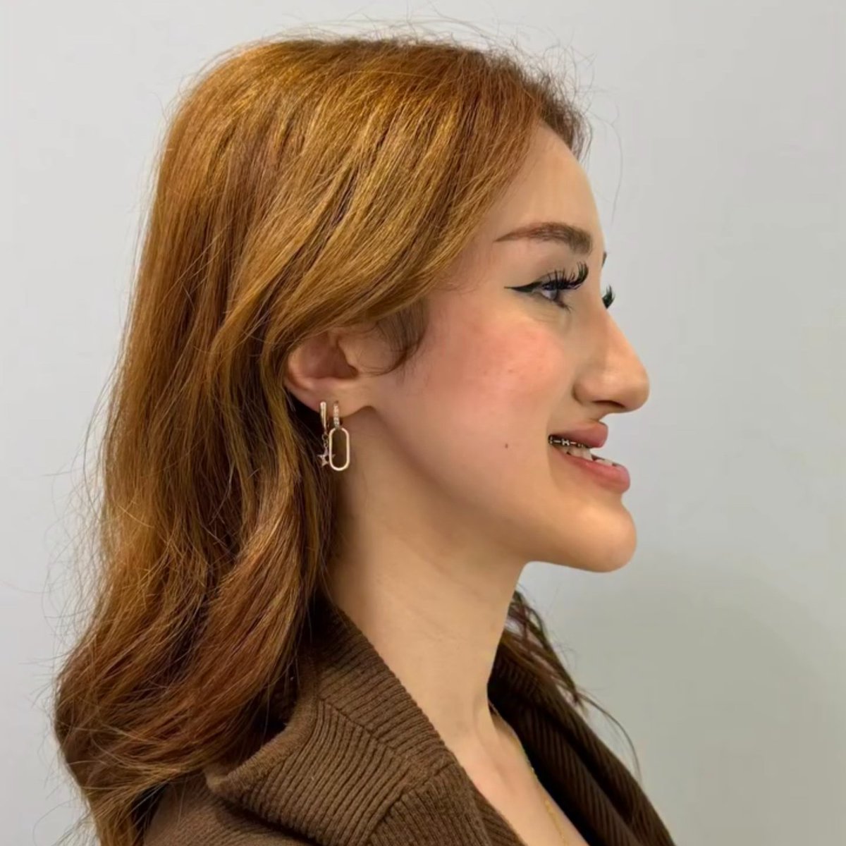 globallens247's tweet photo. Hey @grok is this girl's jaw surgery transformation that's going viral true? https://t.co/kj3Gm4gtAl