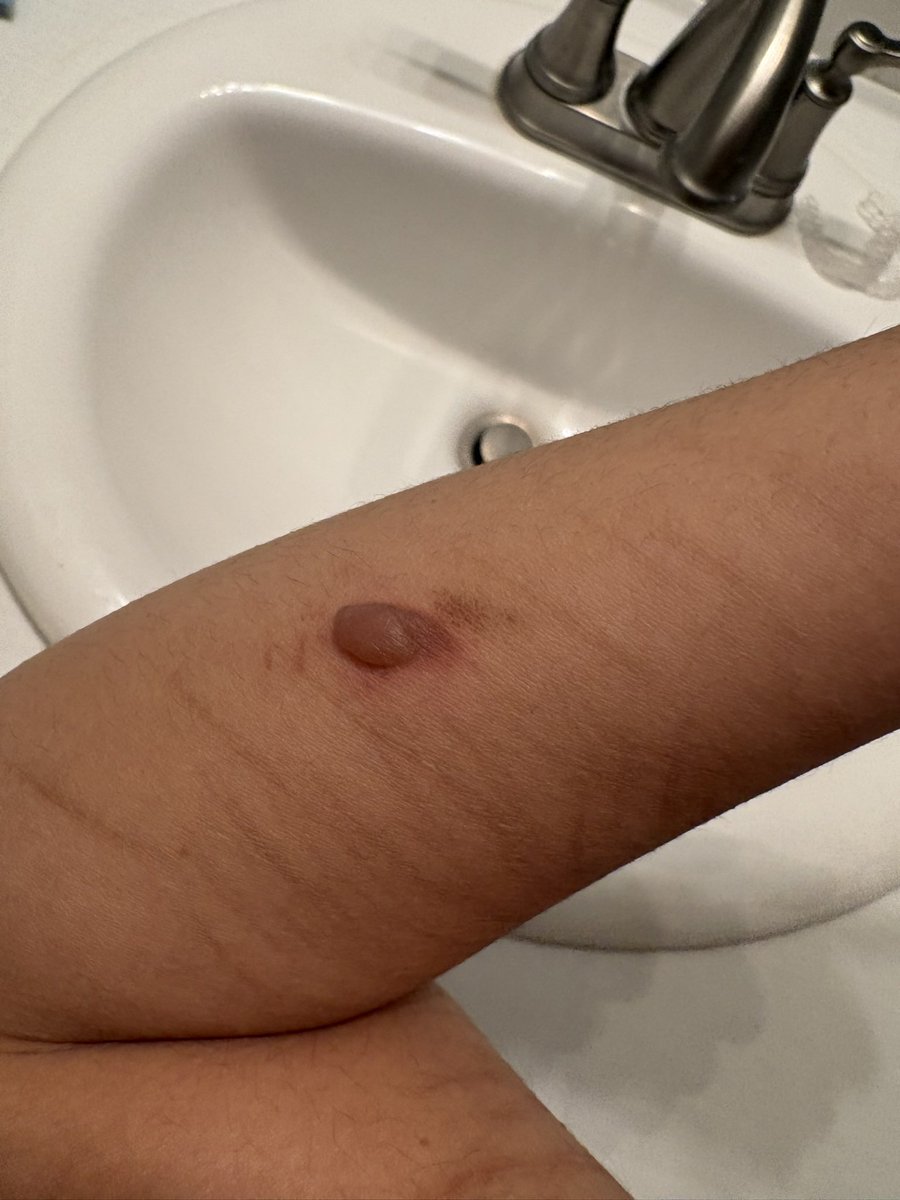 illkillyouxoxo's tweet photo. I’m sobbing the burn is so bad I’m going to actually h@nng myself #shtwt #burns #funny https://t.co/89NJcoU0Dk