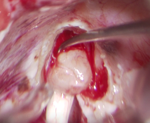 XiefengWang's tweet photo. This is the first case I've encountered in which a patient presented with preoperative facial palsy despite the tumor being confined to the deep internal auditory canal. After gross total resection, facial nerve function has been gradually improving. https://t.co/CFpGmS5Dtx