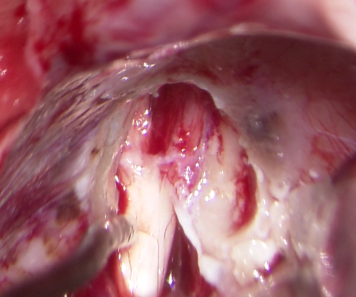 XiefengWang's tweet photo. This is the first case I've encountered in which a patient presented with preoperative facial palsy despite the tumor being confined to the deep internal auditory canal. After gross total resection, facial nerve function has been gradually improving. https://t.co/CFpGmS5Dtx
