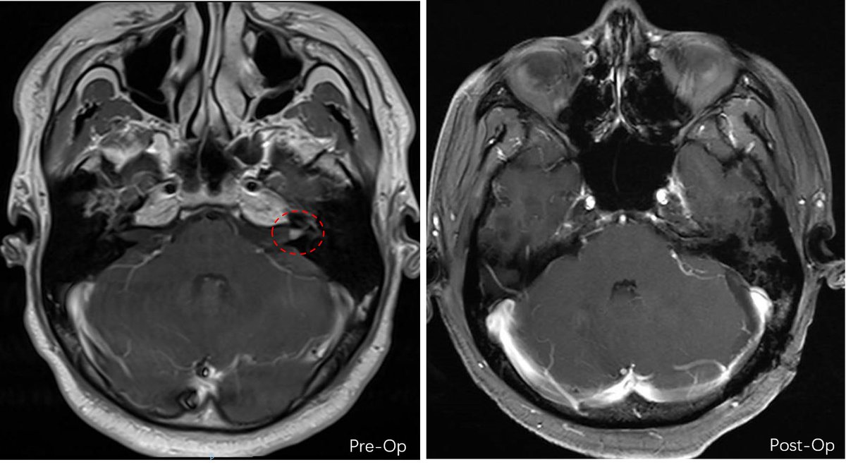 XiefengWang's tweet photo. This is the first case I've encountered in which a patient presented with preoperative facial palsy despite the tumor being confined to the deep internal auditory canal. After gross total resection, facial nerve function has been gradually improving. https://t.co/CFpGmS5Dtx