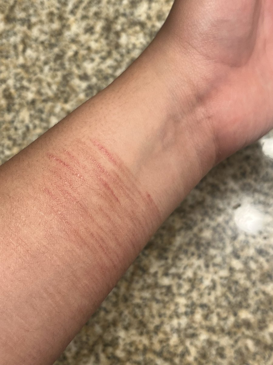 puddingpuppy__'s tweet photo. Scars r so red ….. … Woaow …. I hope they stay rlly rlly prominent and apparent for awhile  …. When winter comes my arms will be COVERED with new scars I hope. Ok goodnight mooties ily alllll <333 
#shedtwt #ouchietwt https://t.co/BAWfnoujtH