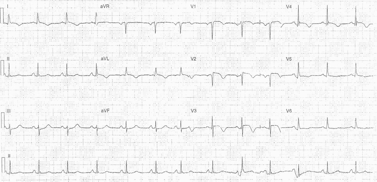 ManualOMedicine's tweet photo. A 60-year-old female who was competing in a triathlon became short of breath. She was found to be hypothermic (32 C / 89.6 F) at the scene but normothermic on arrival to the Emergency Department (36 C / 96.8 F).
- What’s your interpretation ?
#medtwitter #foame #ecg #cardioed https://t.co/kE59SelkNJ