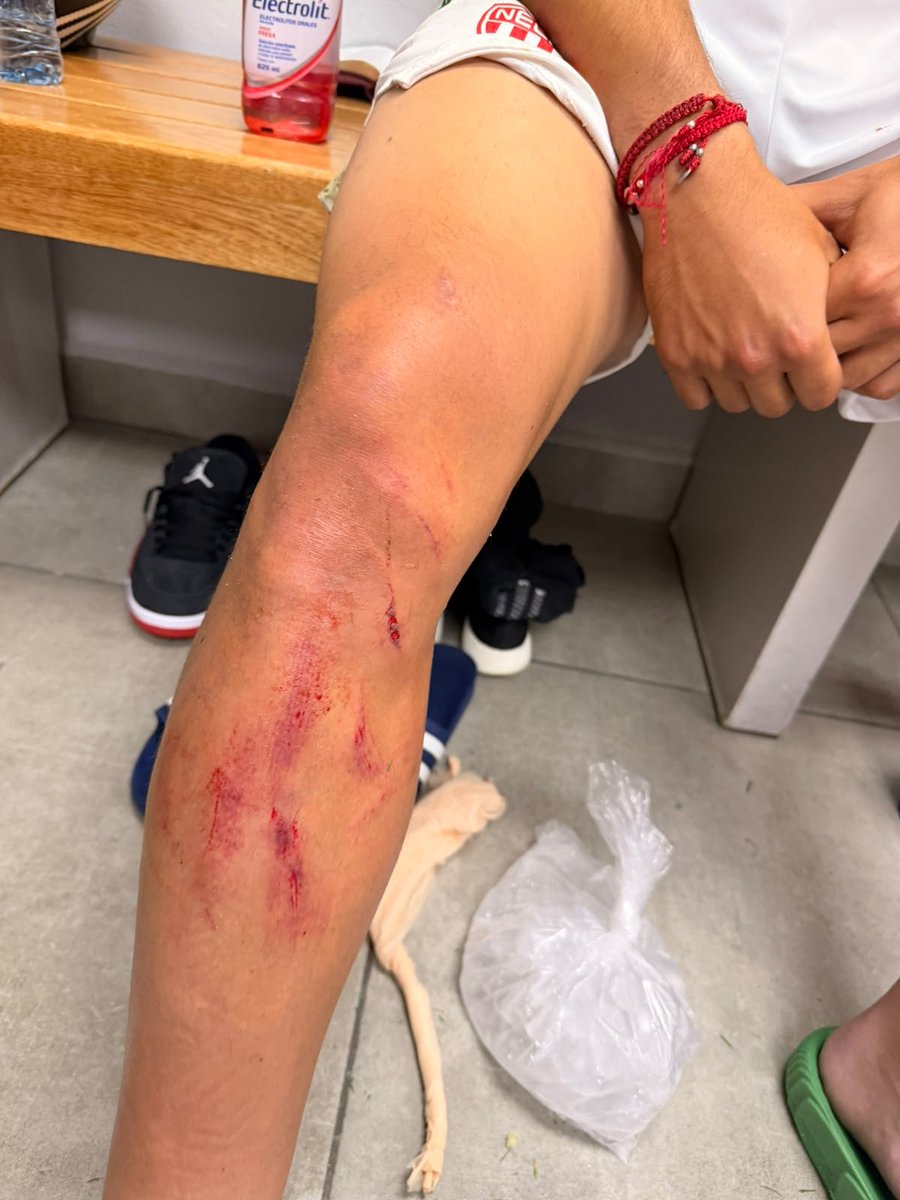 fantasmasuarez's tweet photo. Así quedo la pierna de Oliveros del @ClubNecaxa
e increíblemente NO fue tarjeta roja para Helinho de @TolucaFC
Muy grave error del VAR. https://t.co/VfWrTvGL7n