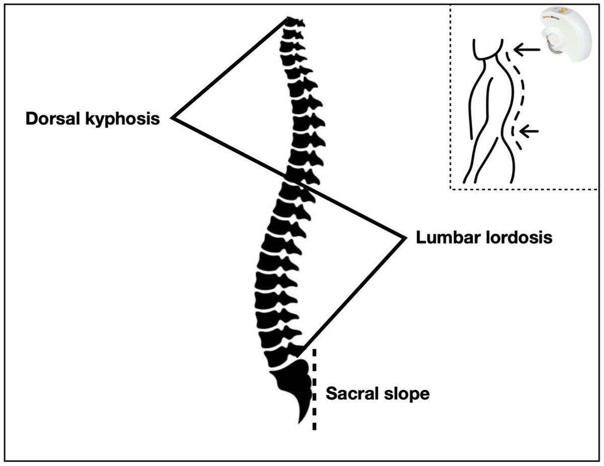 Biomech_MDPI's tweet photo. 🔓#callforreading
📢 The Effect of #Ankle Dorsiflexion on Sagittal Posture and Core #Muscle Activation
 by Miguel Reis e Silva and Lucie Lerebourg
📌Views 4920
🔎Please free read at https://t.co/LSFbv4WtW7
#kinematics #gait #electromyography #spinal #alignment #lowbackpain #ankle https://t.co/hKozhBOMEM