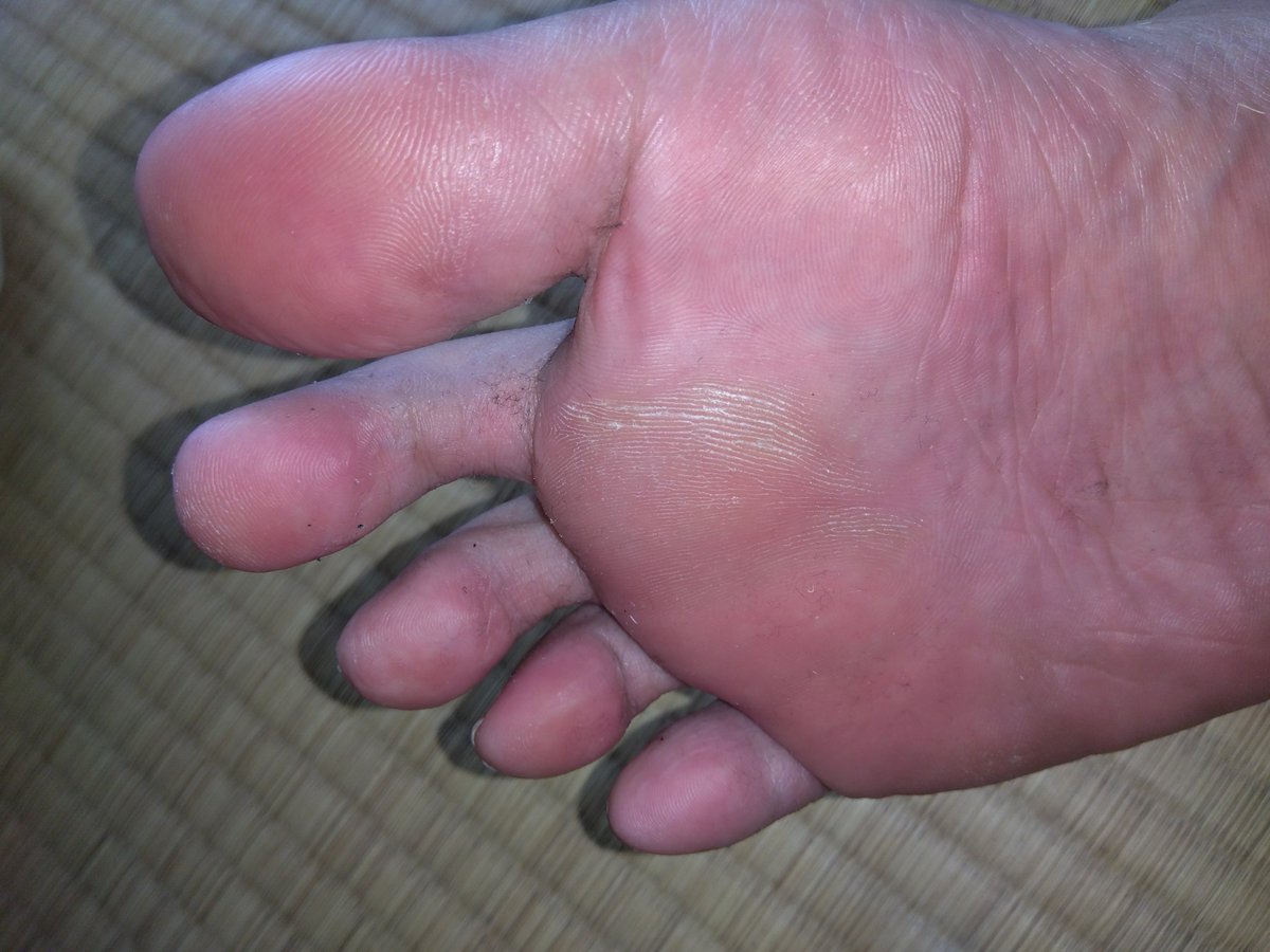 Xo4n3's tweet photo. 用事から帰ってきた直後の脱ぎた��ホカホカ足裏👣指の股がじっとりしてゴミ溜まってたから、そのまま撮ってみたw 左右で汚れ方が違うのもリアルでいい☺️
​#男の足裏 #足裏 #素足 #蒸れ足 #扁平足 #ゲイ #GayFeet #MaleFeet https://t.co/OVuM0Bcm6z
