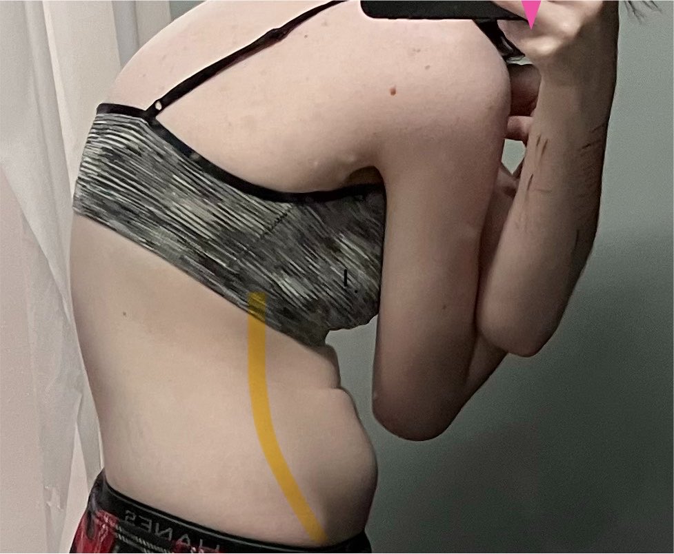 CinnaStarves's tweet photo. okay but the way you can SEE where the fat shouldn't be. i feel disgusted https://t.co/7C3C9rBNlV