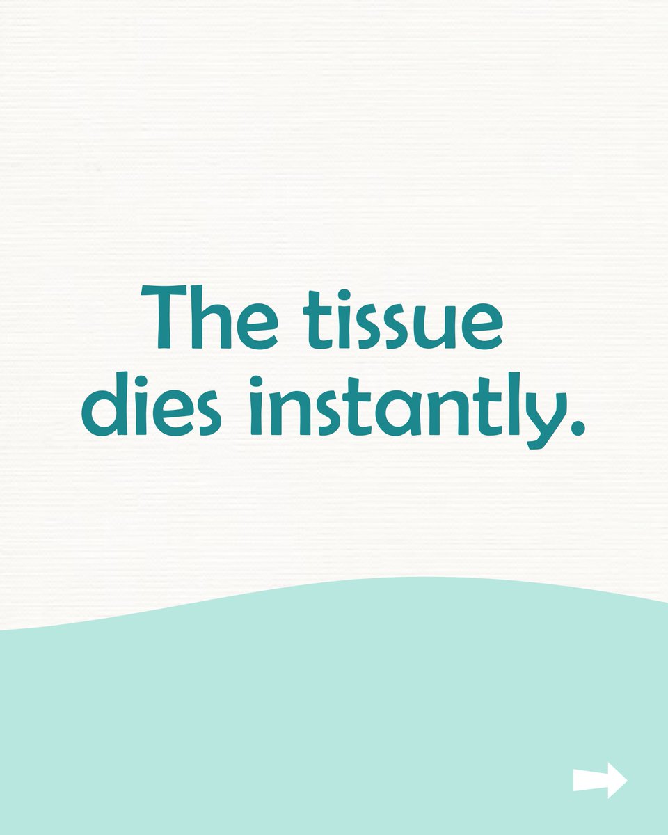 irclinic2018's tweet photo. We destroy it where it is, and then the body takes over, your immune system clears what's left and turns it into a tiny scar.
Contact +919913535351.
#InterventionalRadiology #AlternativeToSurgery  #MicrowaveAblation #MinimallyInvasive #AdvancedHealthcareInnovation #IRClinicndia https://t.co/EBOBQC4Roi