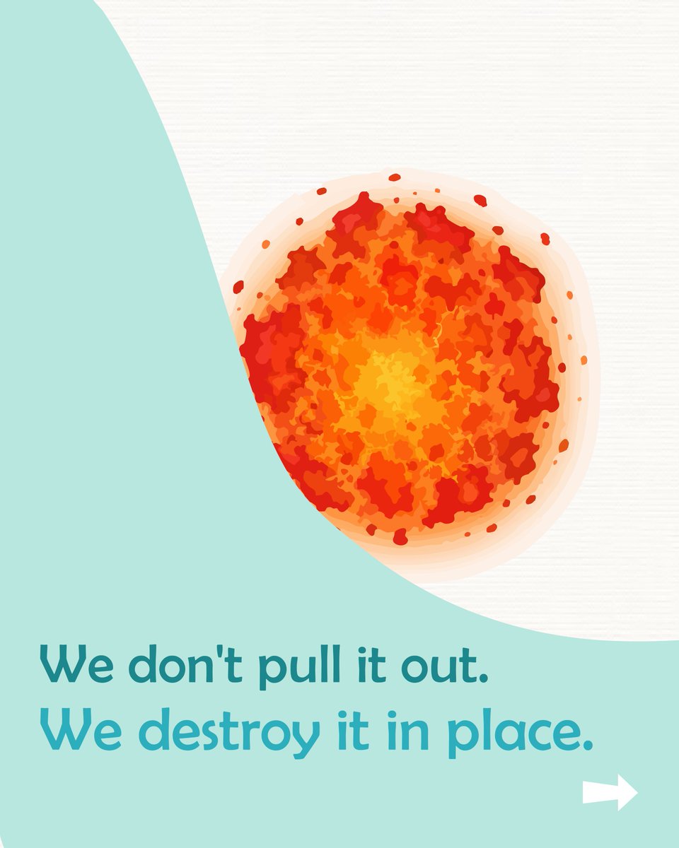 irclinic2018's tweet photo. We destroy it where it is, and then the body takes over, your immune system clears what's left and turns it into a tiny scar.
Contact +919913535351.
#InterventionalRadiology #AlternativeToSurgery  #MicrowaveAblation #MinimallyInvasive #AdvancedHealthcareInnovation #IRClinicndia https://t.co/EBOBQC4Roi